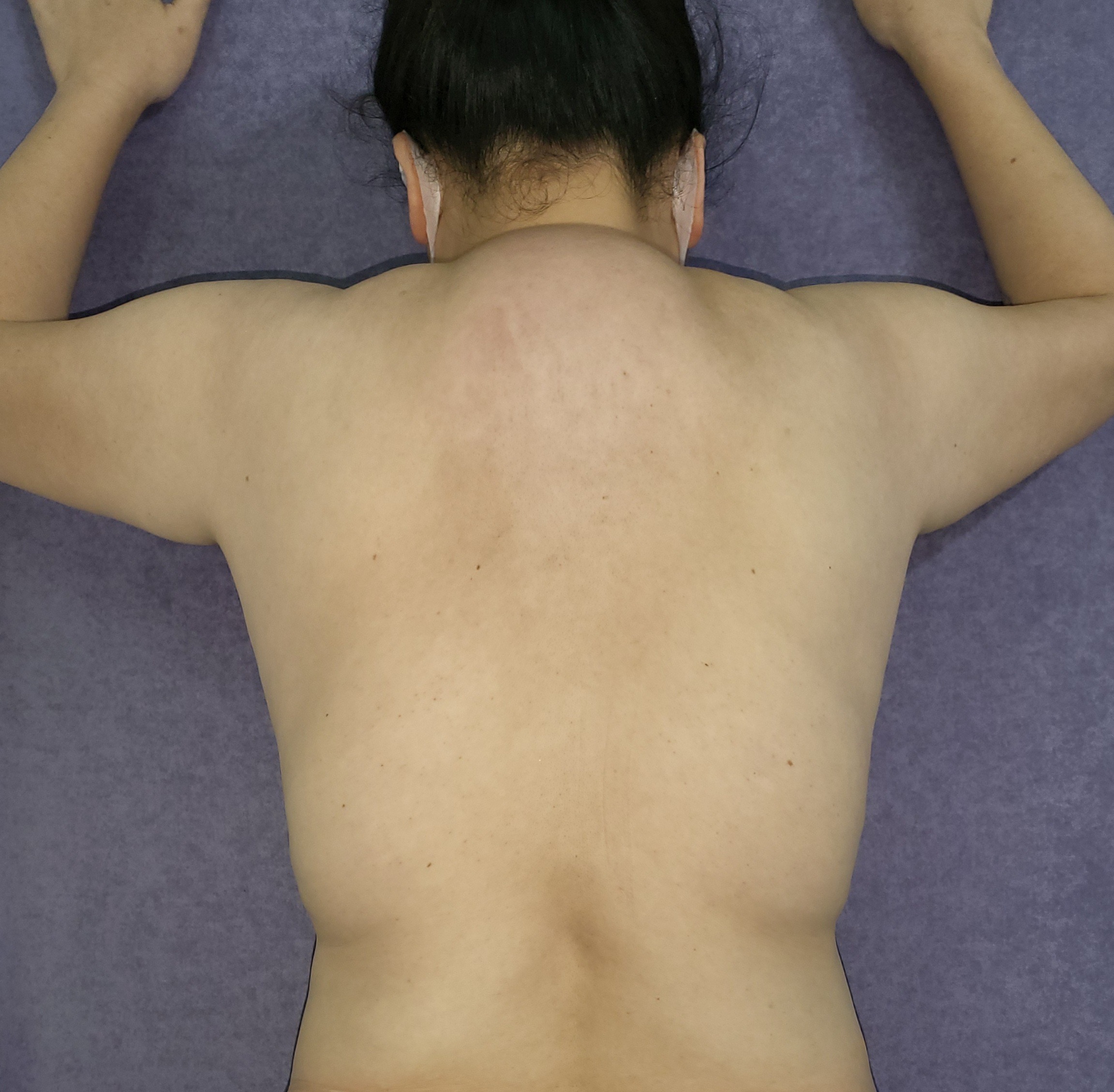 Cảnh giác với căn bệnh u mỡ đối xứng rất hiếm gặp ở phụ nữ