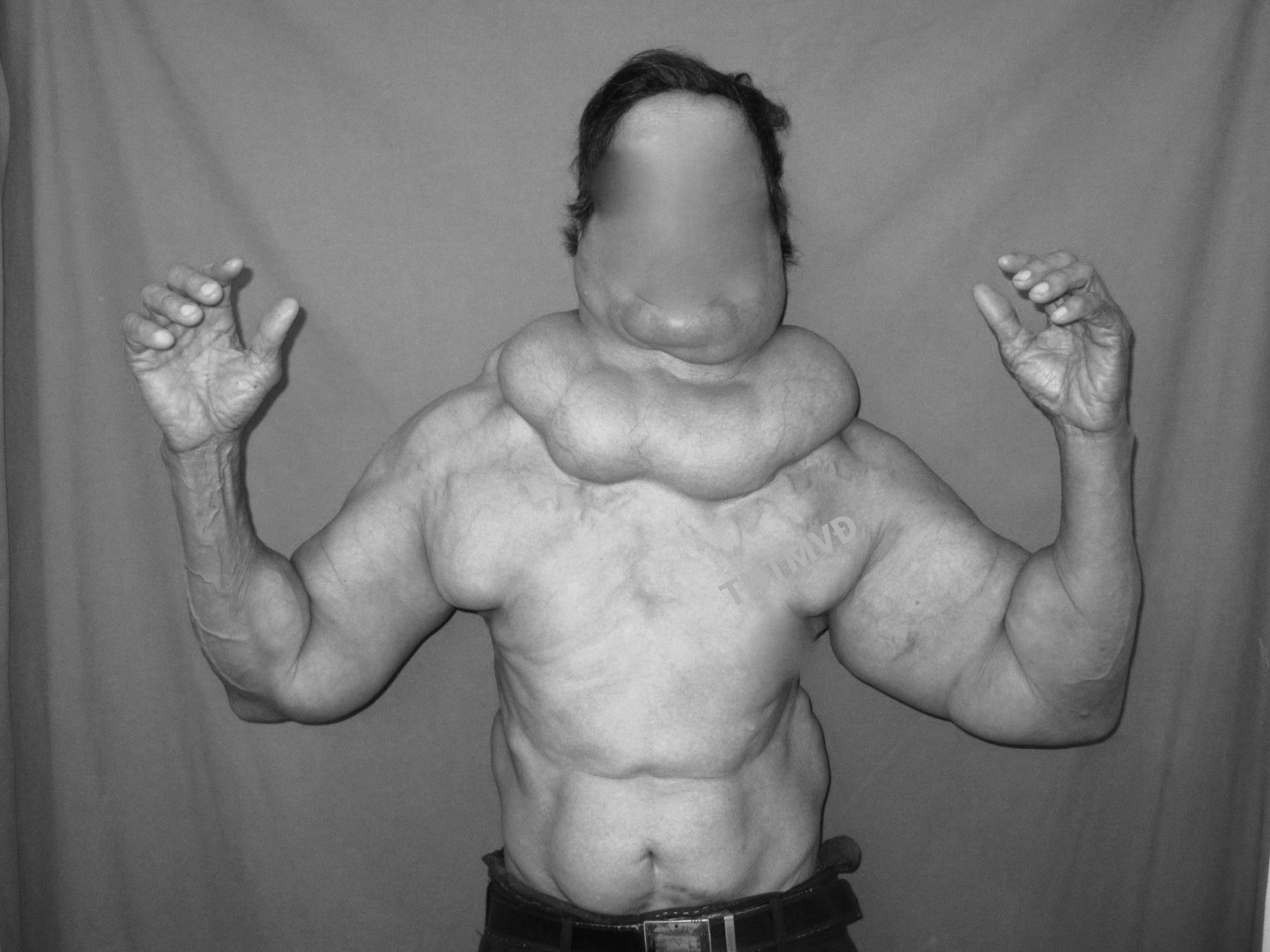 Cảnh giác với căn bệnh u mỡ đối xứng rất hiếm gặp ở phụ nữ