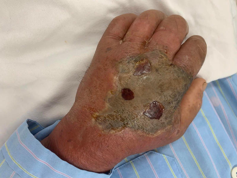 Bị rắn độc cắn nhưng tự điều trị tại nhà, bệnh nhân nhập viện nguy kịch Bị rắn độc cắn nhưng tự điều trị tại nhà, bệnh nhân nhập viện nguy kịch