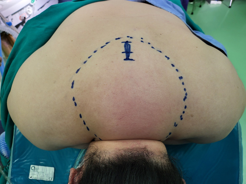 Cảnh giác với căn bệnh u mỡ đối xứng rất hiếm gặp ở phụ nữ