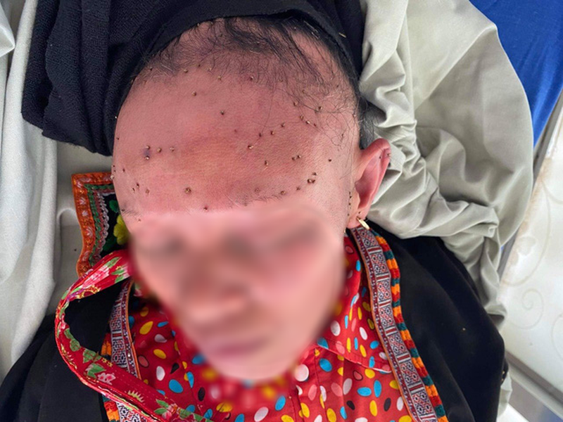 Đang làm cỏ, người phụ nữ bị đàn ong tấn công