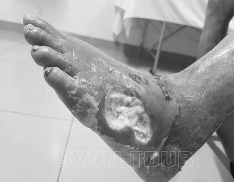 Người bệnh đái tháo đường bị nhiễm trùng, hoại tử bàn chân do tự ý dùng thuốc