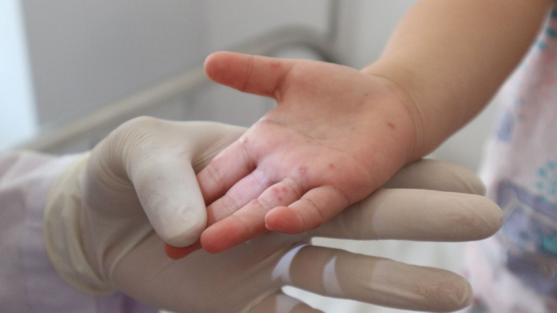 TP. Hồ Chí Minh ghi nhận hơn 7.600 ca mắc tay chân miệng