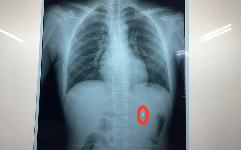 Xem bắn chim trời, thiếu niên 16 tuổi bị đạn bắn thấu thận