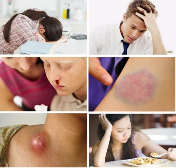 Chàng trai 24 tuổi đến BV xin cắt amidan thì bất ngờ phát hiện ung thư máu: Bác sỹ viện ĐH Y cảnh báo đừng chủ quan với những triệu chứng thường gặp - Ảnh 2.