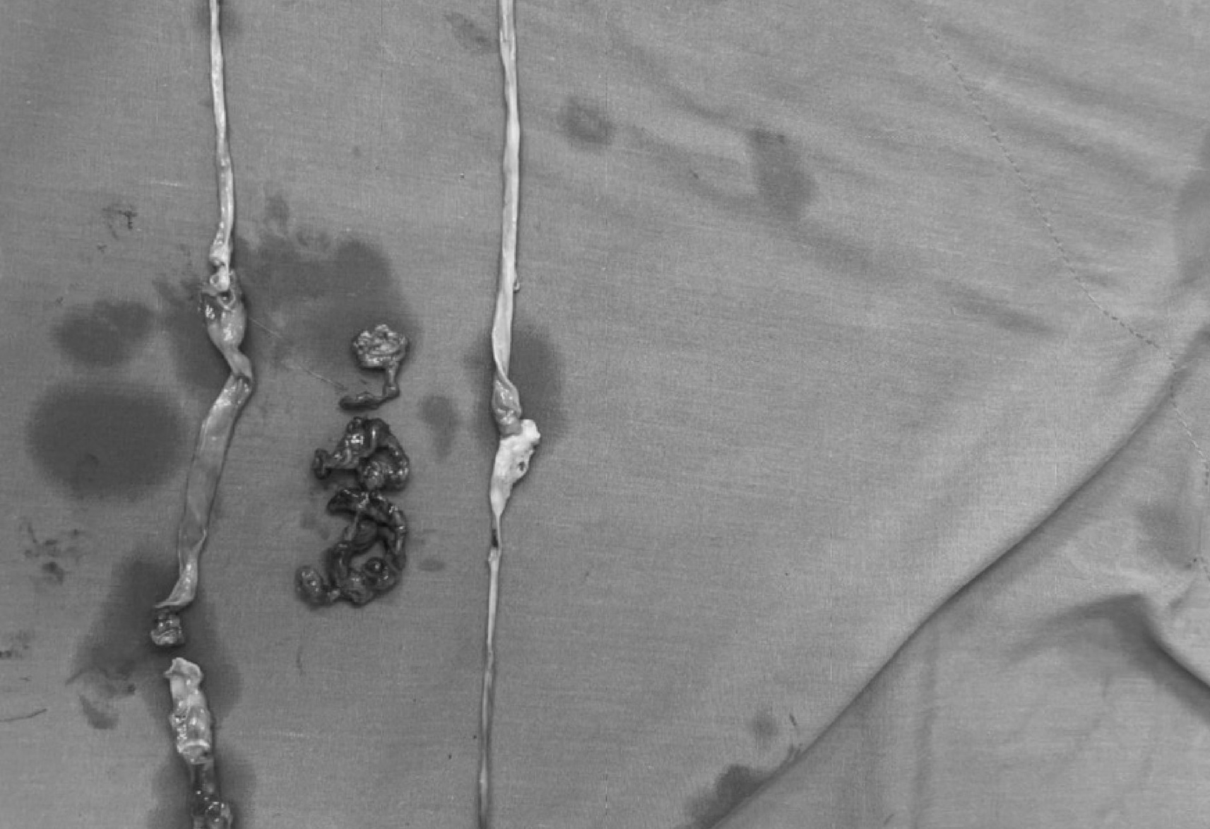 Nhập viện cầu cứu bác sĩ vì tĩnh mạch giãn ngoằn ngoèo dưới da