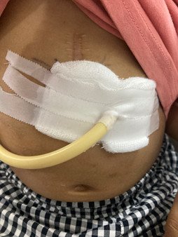 Cảnh báo bỏng thực quản do uống nhầm hoá chất ở trẻ