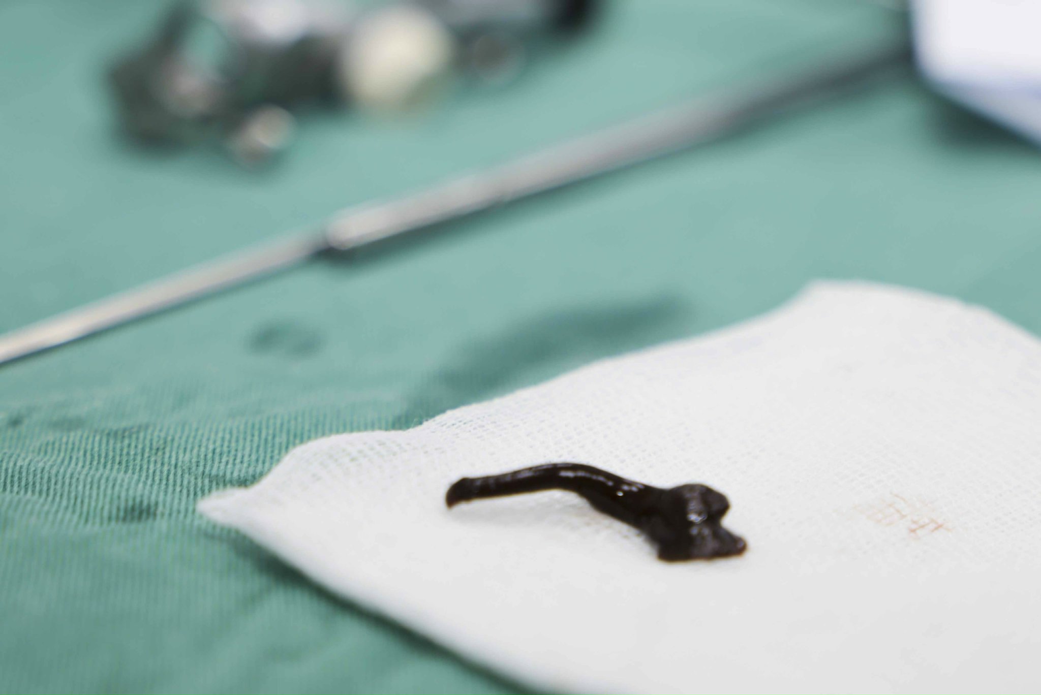 Đi khám vì ho ra máu, khàn tiếng, bác sĩ tìm ra thủ phạm ký sinh trong đường thở bệnh nhi