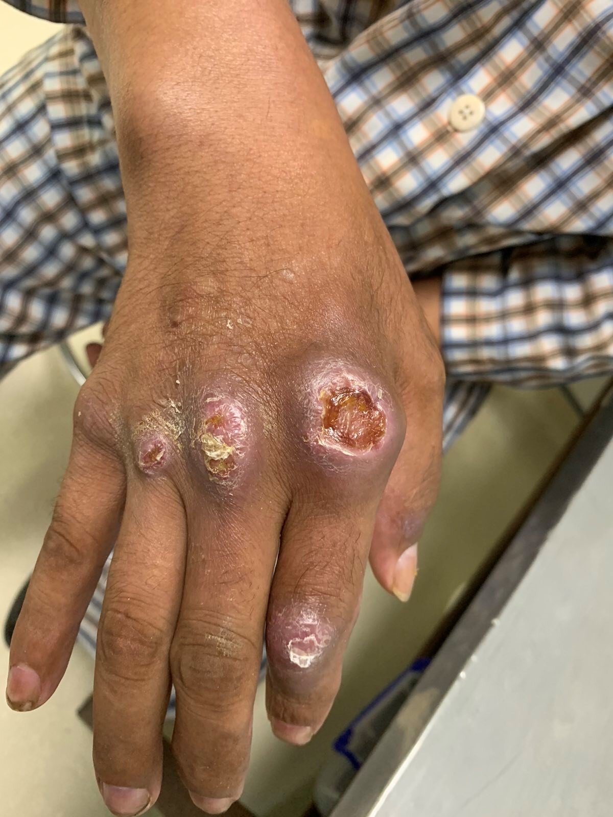 Cẩn trọng biến chứng cổ tay, bàn tay khi tiêm thuốc vào khớp để giảm đau