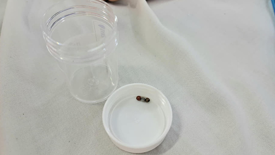 Chơi bi nam châm xếp hình, bé gái 3 tuổi bị thủng ruột