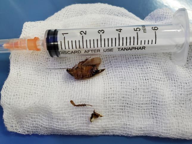 Khám tai đau, bác sĩ gắp ra cả... ve chó, gián còn sống trong tai bệnh nhân