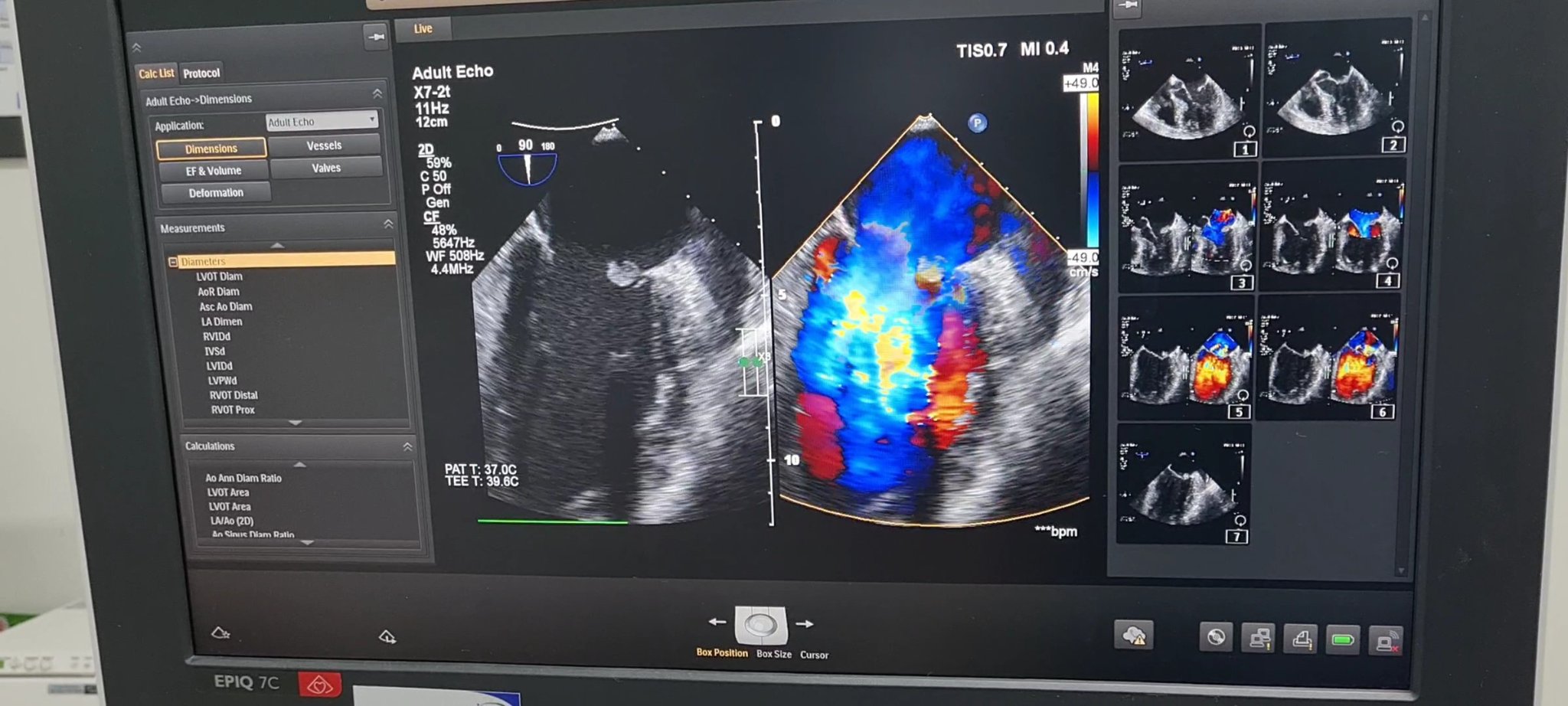 Cảnh báo: Hiểm hoạ tim mạch khôn lường vì tiêm thuốc giảm đau vào khớp tại phòng khám tư nhân