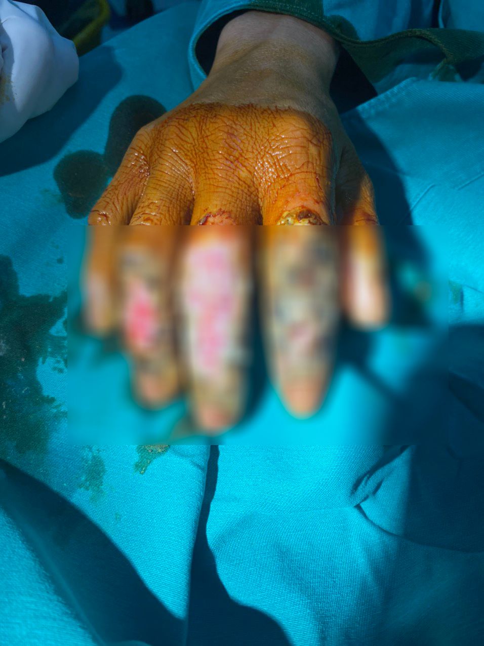 Bàn tay nhiễm trùng nặng do đắp thuốc nam chữa bỏng