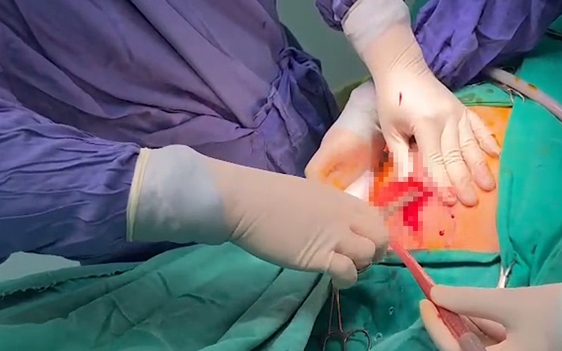 Tiêm filler nâng ngực tại spa, một phụ nữ phải nhập viện vì biến chứng