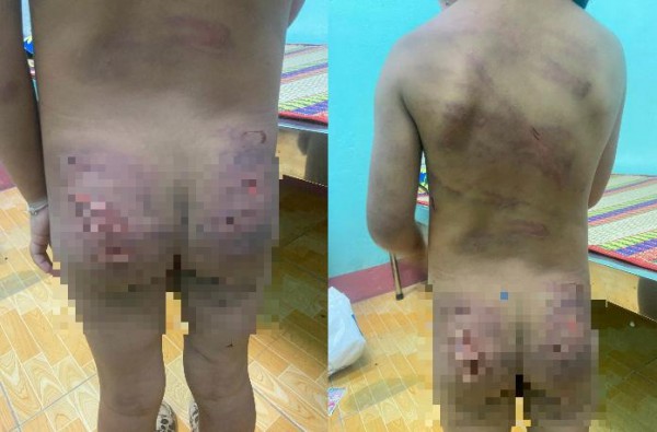 Bình Phước: Khởi tố mẹ ruột và cha dượng hành hạ bé gái 7 tuổi