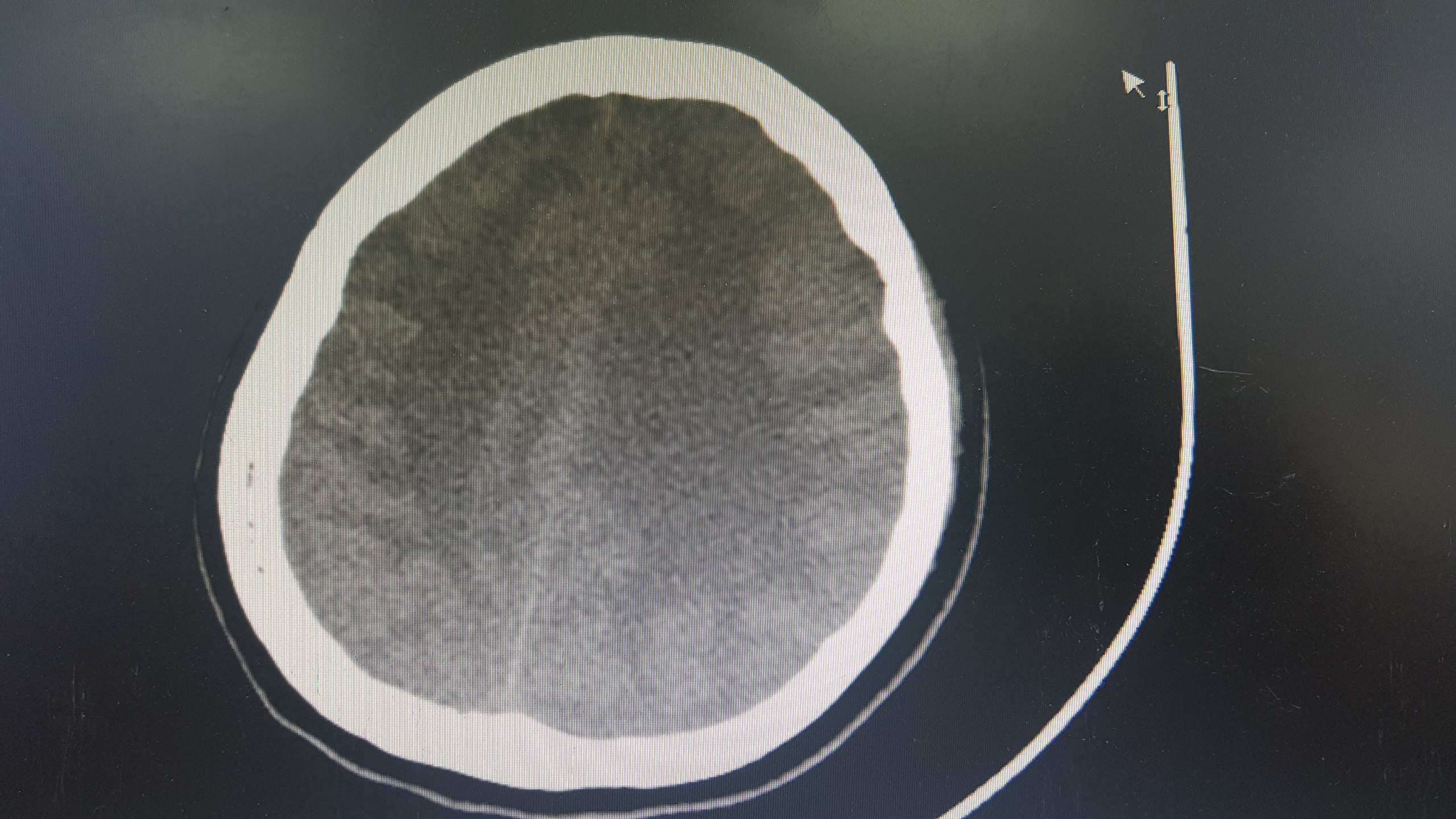 Hôn mê sâu sau dùng thuốc lá điện tử