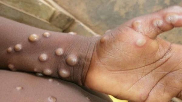 Ấn Độ giám sát sân bay, cửa khẩu để ngăn đậu mùa khỉ