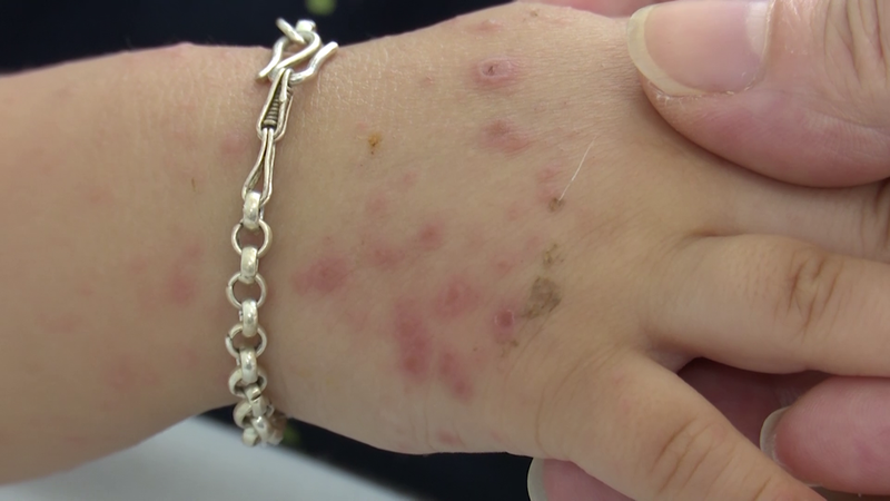 Bệnh tay chân miệng gia tăng, cảnh giác biến chứng nặng