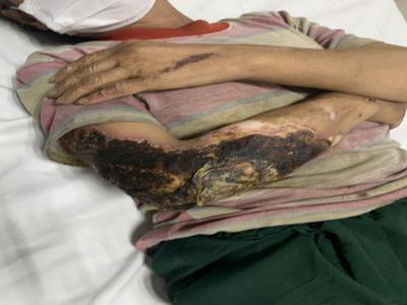 Bị nhiễm trùng nặng do tự ý sử dụng nước chè, mật ong chữa bỏng Bị nhiễm trùng nặng do tự ý sử dụng nước chè, mật ong chữa bỏng