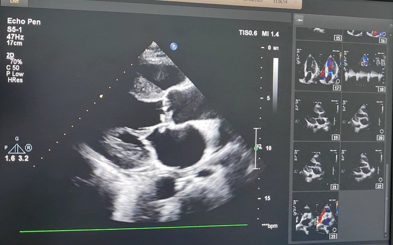 Cảnh báo: Hiểm hoạ tim mạch khôn lường vì tiêm thuốc giảm đau vào khớp tại phòng khám tư nhân