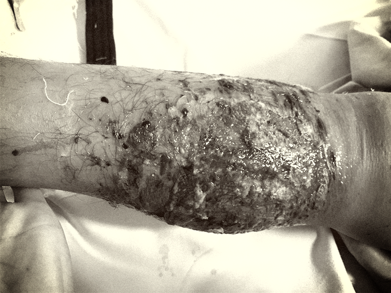 Cảnh báo biến chứng nặng do sử dụng thuốc nam chữa gãy xương