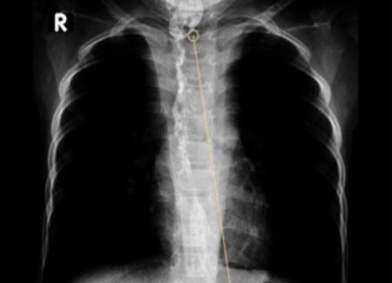 Cảnh báo bỏng thực quản do uống nhầm hoá chất ở trẻ