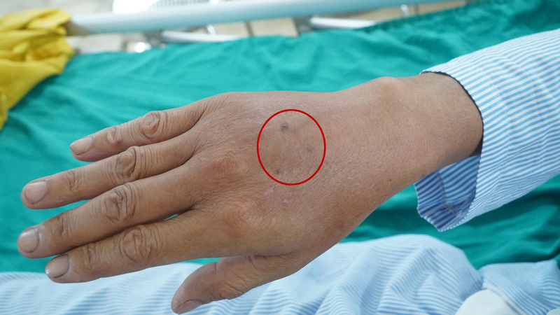 Cấp cứu bệnh nhân sốc phản vệ nguy kịch do ong vò vẽ đốt