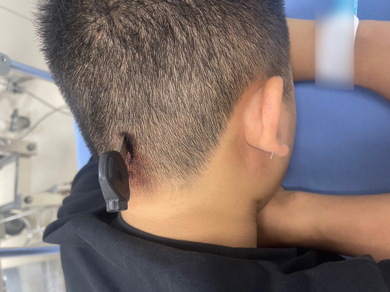 Cấp cứu nam thanh niên bị chìa khóa... cắm vào đầu