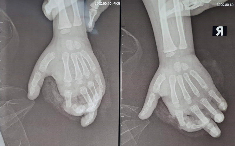 Cho tay vào máy xay sinh tố, bé gái 4 tuổi bị nghiền nát tay Cho tay vào máy xay sinh tố, bé gái 4 tuổi bị nghiền nát tay