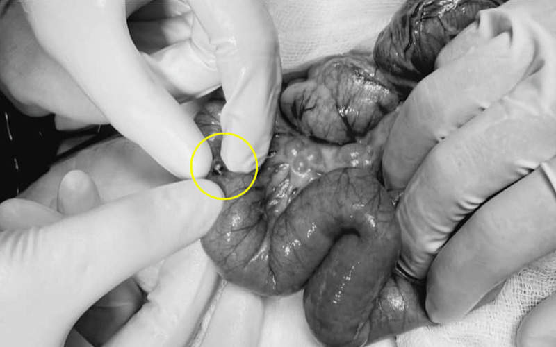 Chơi bi nam châm xếp hình, bé gái 3 tuổi bị thủng ruột