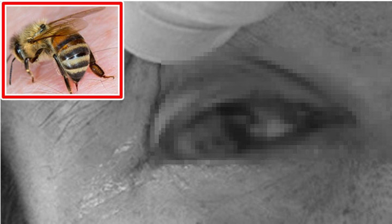 Hy hữu: Bệnh nhân bị ong đốt vào mắt khi đang làm vườn