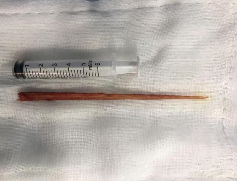 Lấy dăm gỗ dài 15cm găm vào thành ngực bệnh nhân
