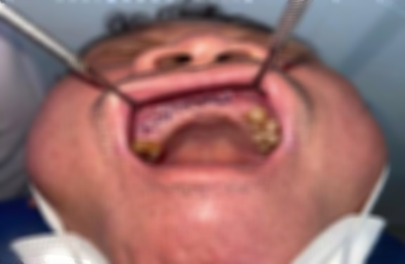 Người đàn ông bị hoại tử xương hàm trên hậu COVID-19 Người đàn ông bị hoại tử xương hàm trên hậu COVID-19