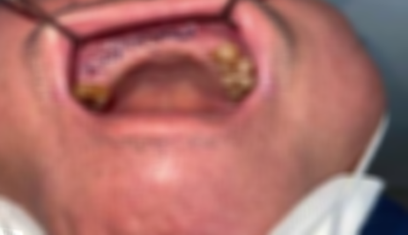 Người đàn ông bị hoại tử xương hàm trên, từng mắc COVID-19 Người đàn ông bị hoại tử xương hàm trên, từng mắc COVID-19