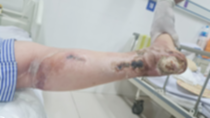 Người phụ nữ phải cắt cụt chân do biến chứng đái tháo đường