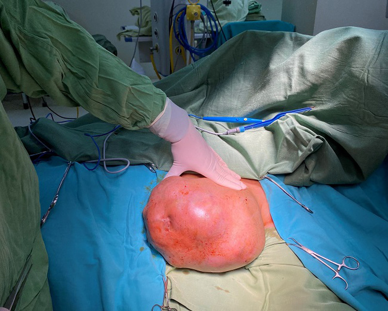 Nhập viện cầu cứu bác sĩ vì khối u vú nặng gần 5kg Nhập viện cầu cứu bác sĩ vì khối u vú nặng gần 5kg