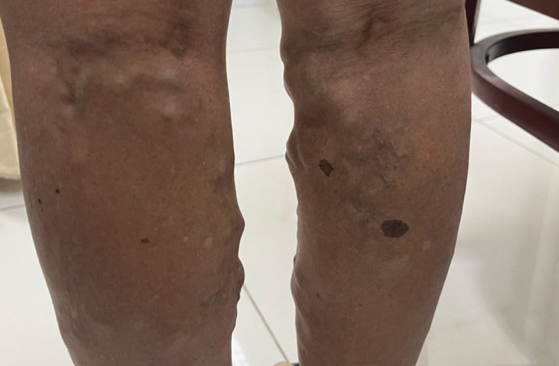 Nhập viện cầu cứu bác sĩ vì tĩnh mạch giãn ngoằn ngoèo dưới da