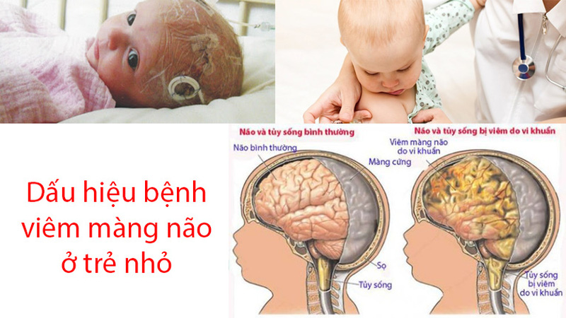 Những dấu hiệu nào báo hiệu bệnh viêm màng não ở trẻ em?