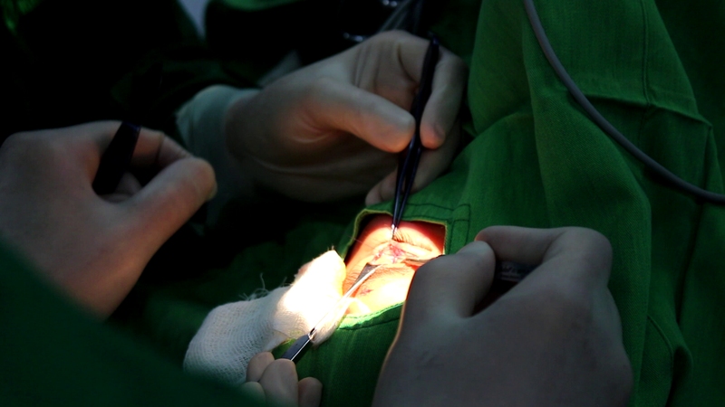 Nổ chai cồn khi đang nướng mực, người đàn ông đứng trước nguy cơ mất thị lực mắt trái