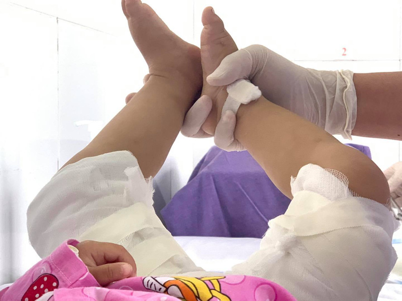 Phòng tránh tai nạn bỏng cho trẻ