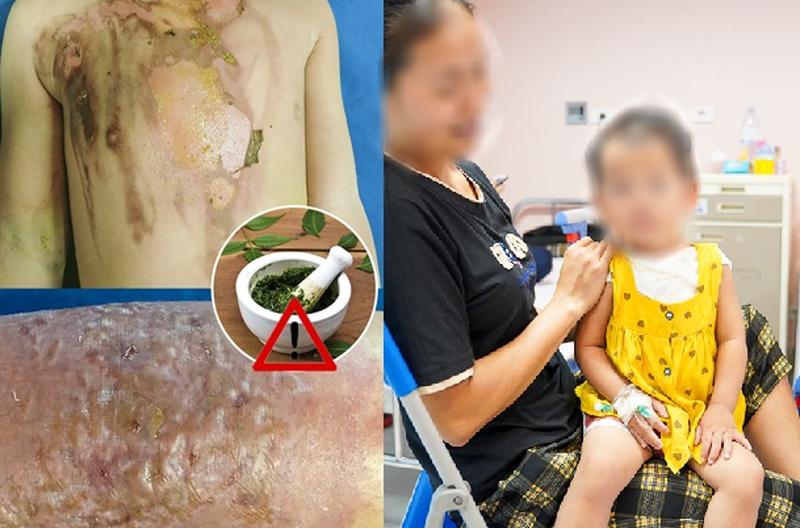 Tự ý đắp lá cây chữa bệnh, nhiều trẻ bị bỏng nặng, nhiễm trùng