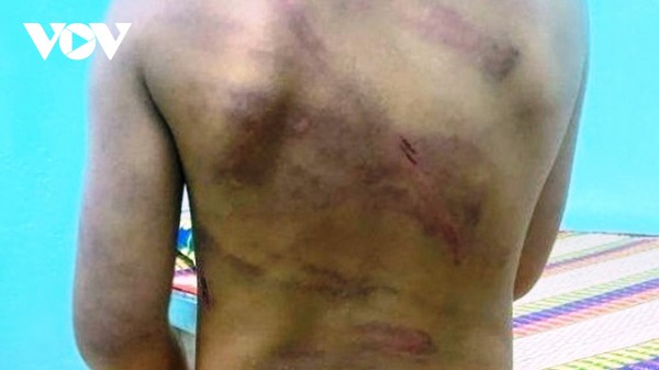 Làm đổ cơm khi ăn, bé gái 7 tuổi ở Bình Phước bị cha dượng đánh dã man