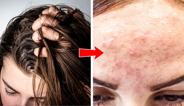 Mụn mọc tại 8 vị trí này bắt nguồn từ các thói quen nhiều người mắc Mụn mọc tại 8 vị trí này bắt nguồn từ các thói quen nhiều người mắc
