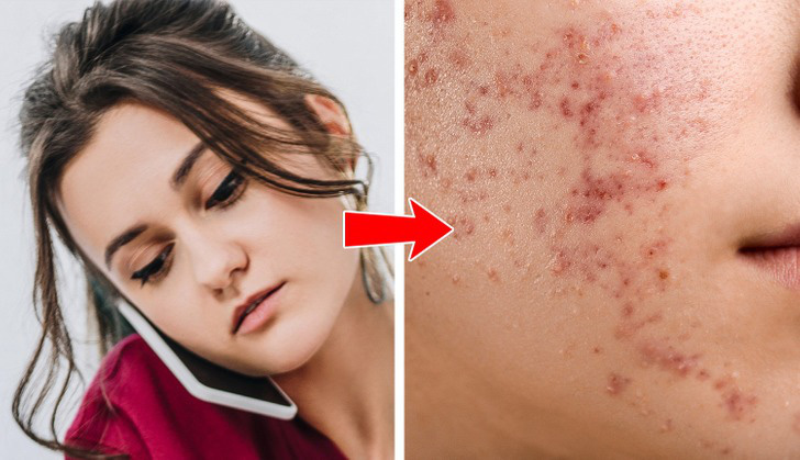Mụn mọc tại 8 vị trí này bắt nguồn từ các thói quen nhiều người mắc Mụn mọc tại 8 vị trí này bắt nguồn từ các thói quen nhiều người mắc