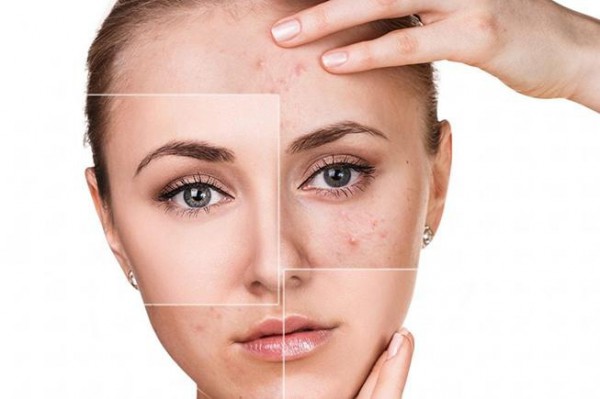 Liệu trình điều trị thâm, sẹo rỗ, sẹo lõm tại nhà