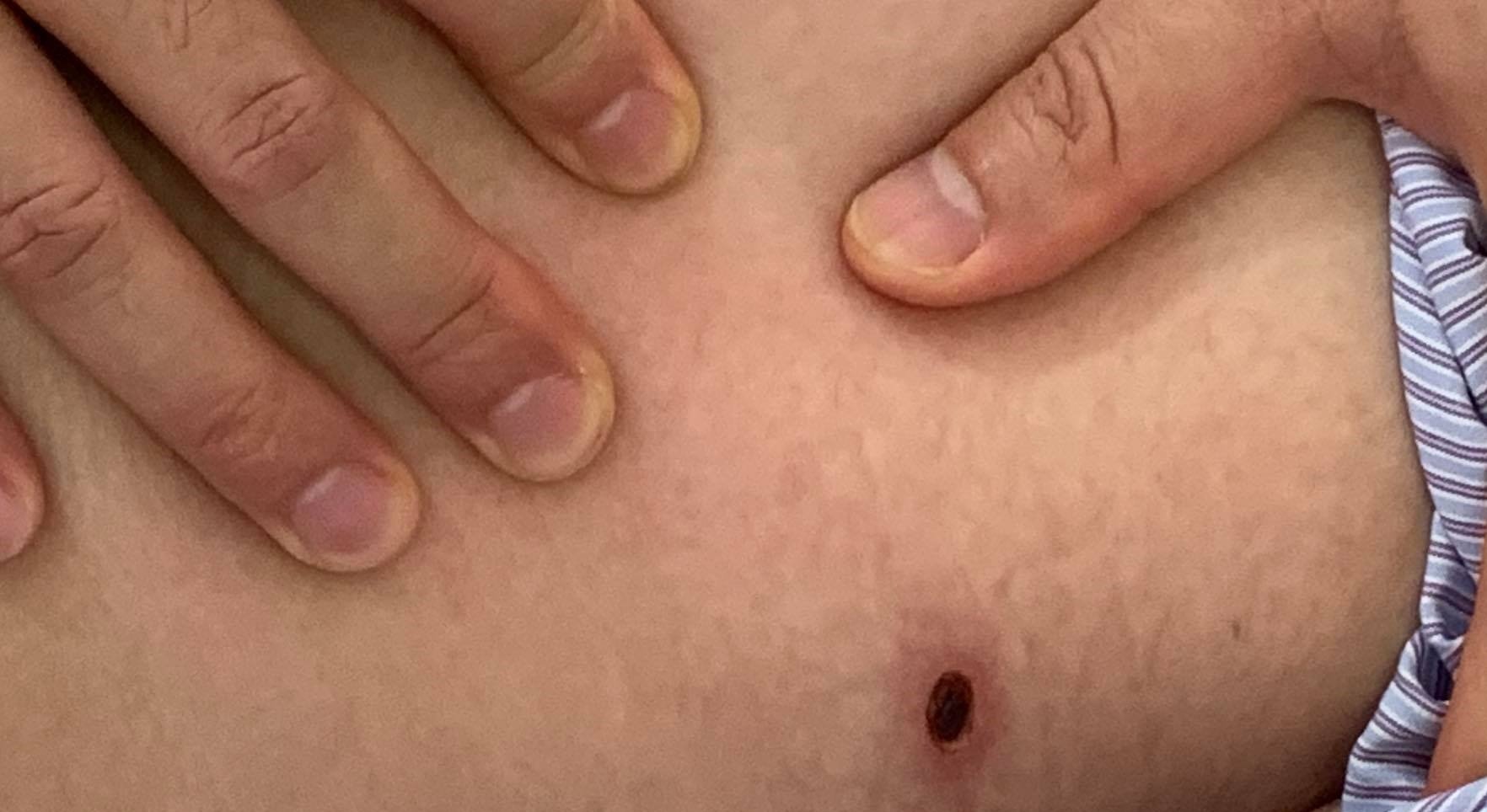 Cảnh báo tình trạng trẻ sốt cao nhập viện do sốt mò