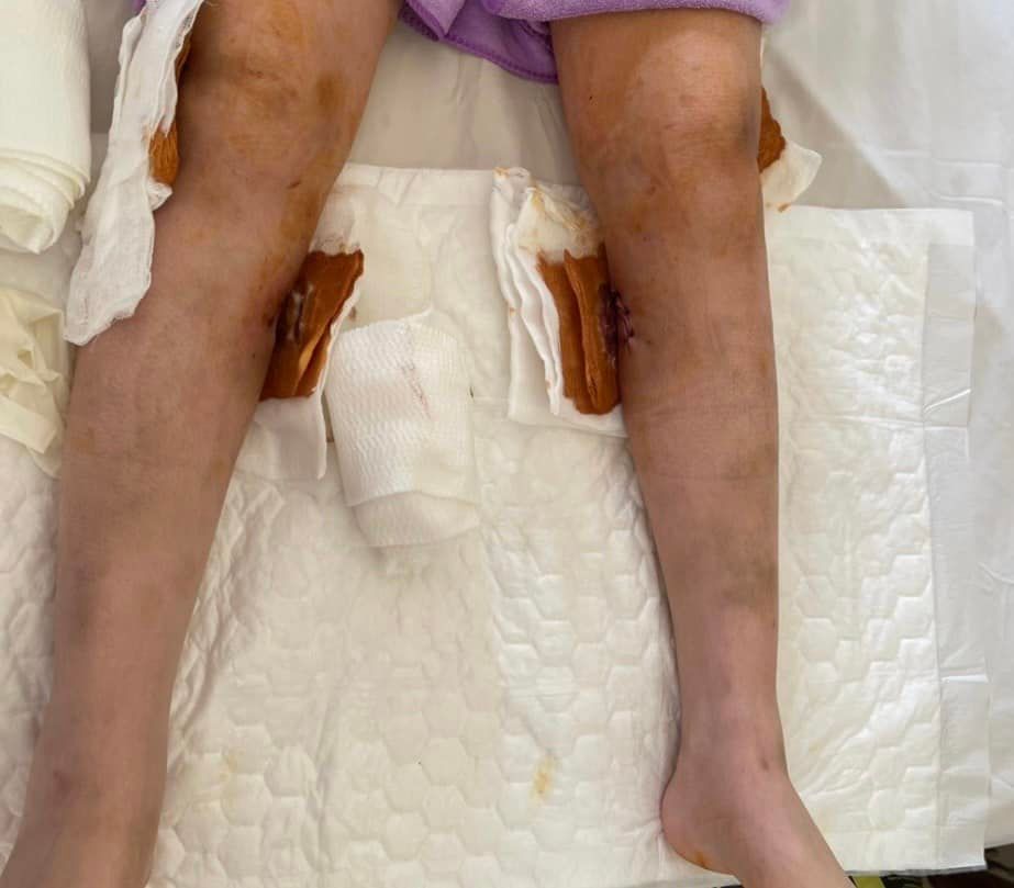 Áp xe gối, cẳng chân sau khi tiêm filler tại spa