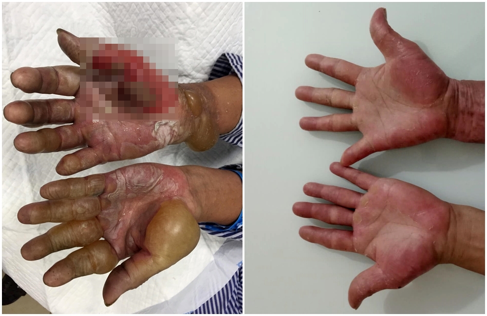 Cẩn trọng với tai nạn bỏng