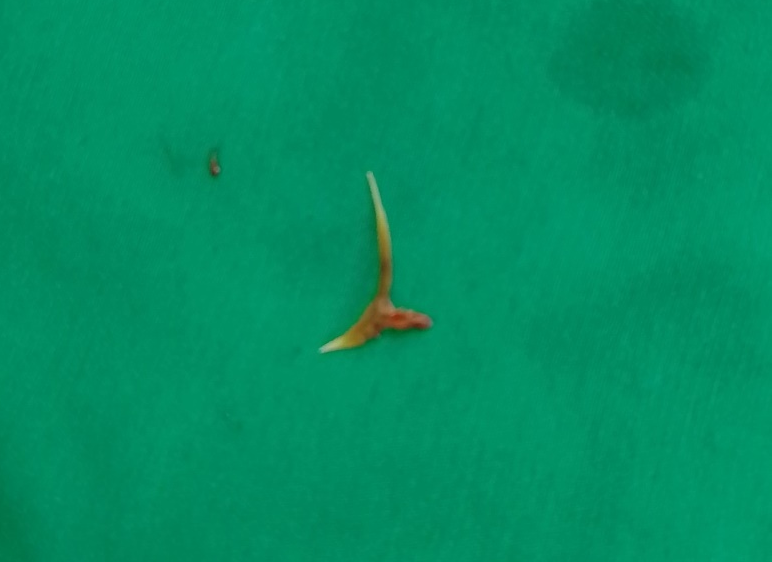 Điều trị ho khắp nơi không khỏi, bất ngờ phát hiện dị vật mắc kẹt trong đường thở Điều trị ho khắp nơi không khỏi, bất ngờ phát hiện dị vật mắc kẹt trong đường thở