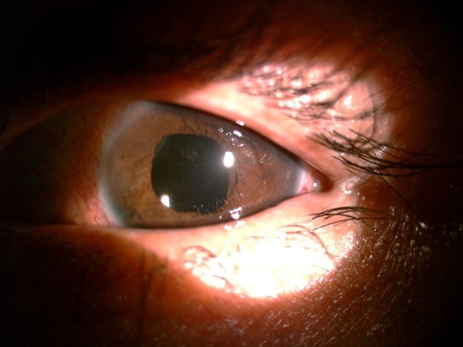 Bơm nước rửa xe, người đàn ông bị vòi xịt gây tổn thương mắt